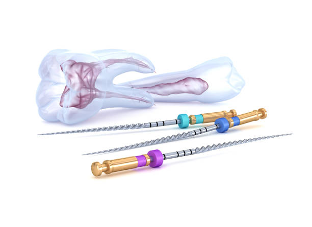 Ošetření kořenových kanálků (endodoncie)